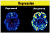 Depression